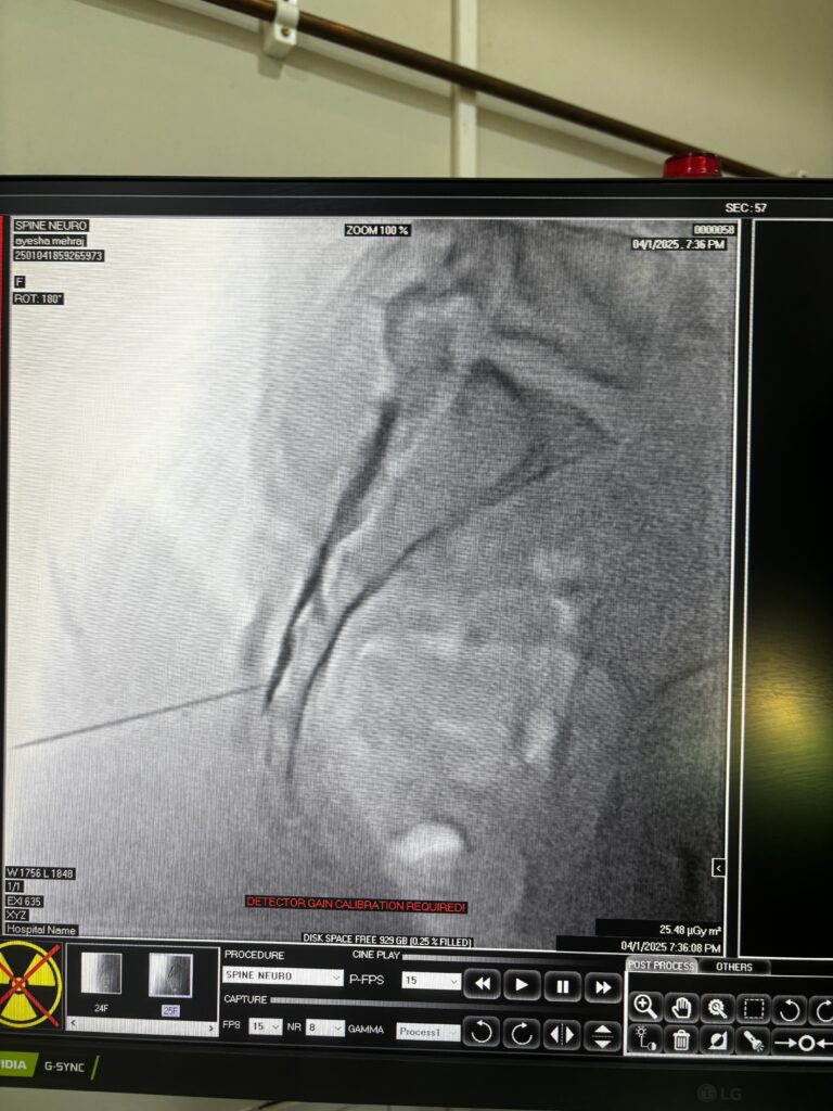 Caudal Epidural injection