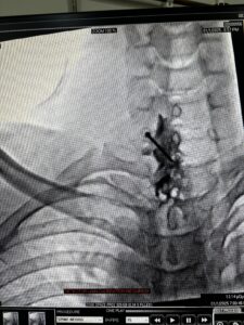Cervical Epidural Injection