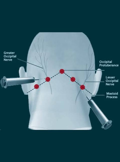 Greater occipital nerve block