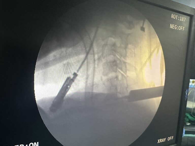 Performing endoscopic cervical spine surgery