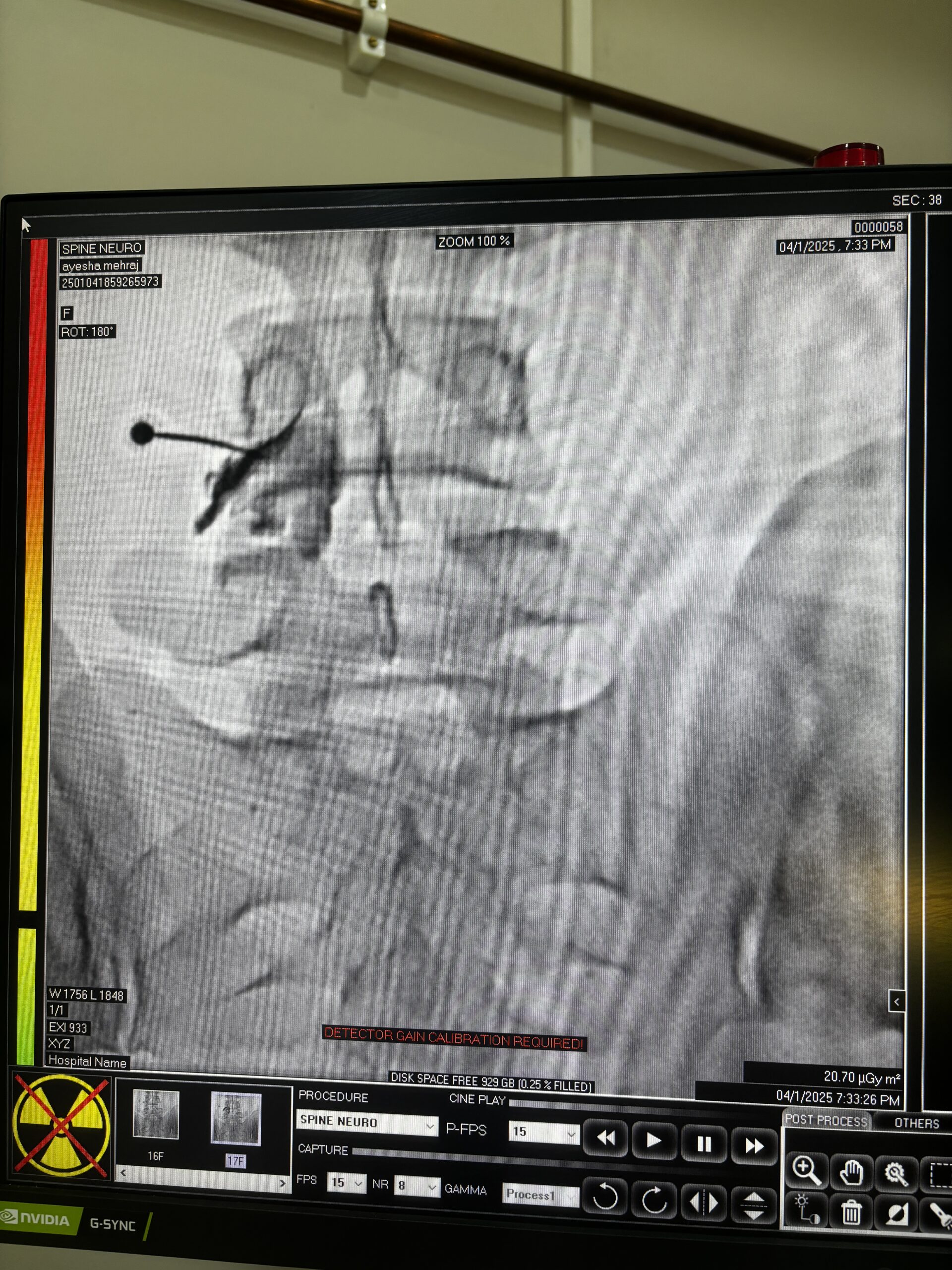 Selective Nerve root block scaled