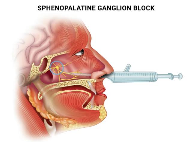 Sphenopalatine ganglion block